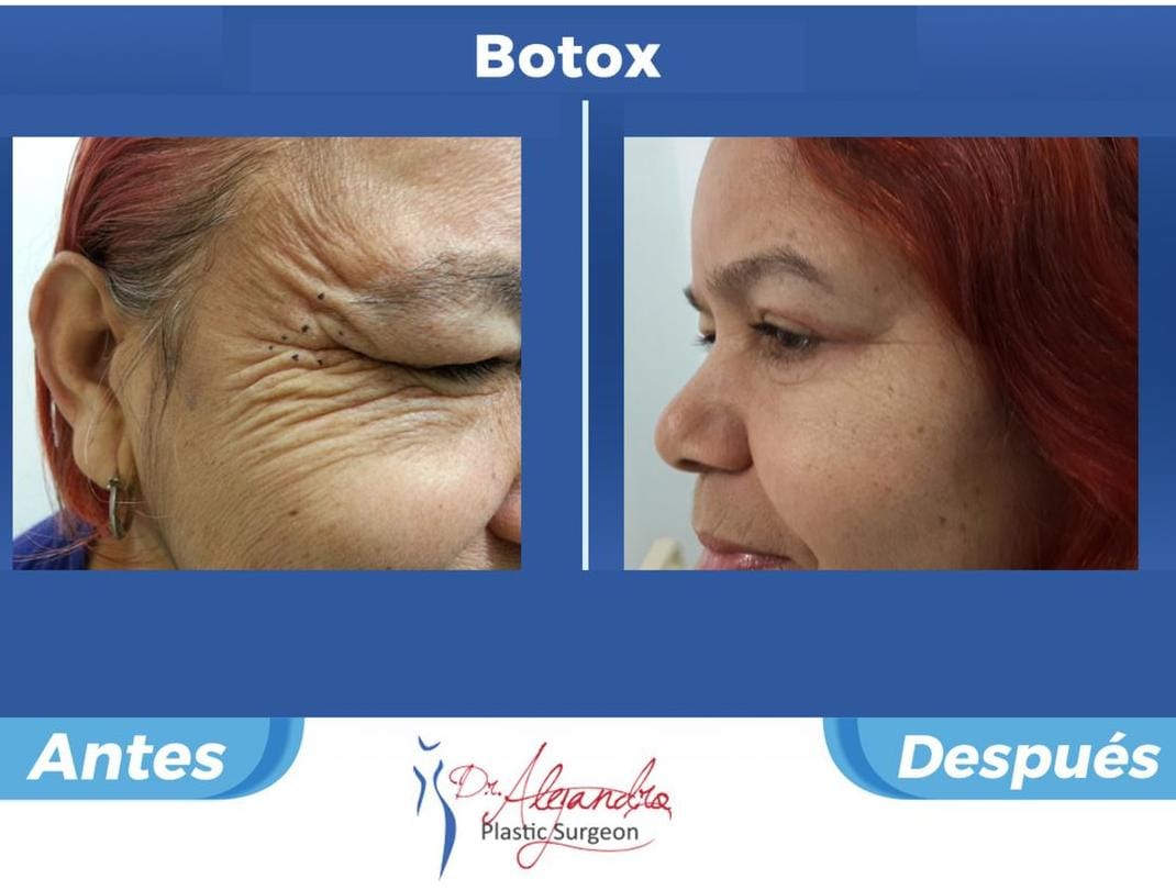 Botox Dr Alejandro Mora