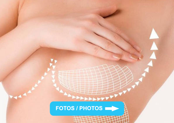 Levantamiento de mamas - Dr Alejandro Mora - Cirujano Plástico y Reconstructivo