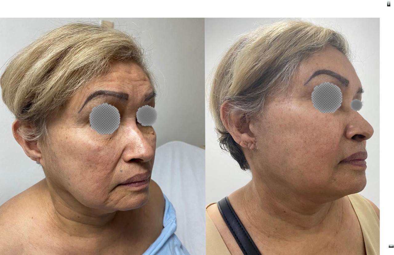 Rejuvenecimiento Facial Dr Alejandro Mora 1